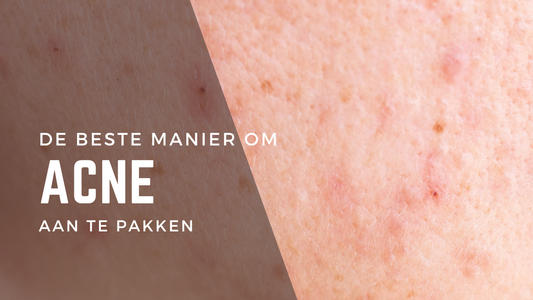 acne verminderen