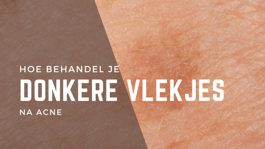 Bruine acne vlekjes: hoe ontstaan ze en wat kun je eraan doen?