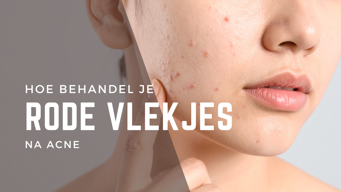 Rode vlekjes na acne: wat zijn het en hoe kom je ervan af?